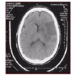 A Ciriè incontri sulla prevenzione e sulla terapia dell’ictus ischemico acuto