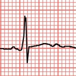 Cardiologia Ciriè-Ivrea all’avanguardia nella cura della fibrillazione atriale