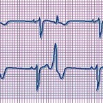 Martedì 27 aprile la Cardiologia Ciriè partecipa a un evento sulle aritmie cardiache